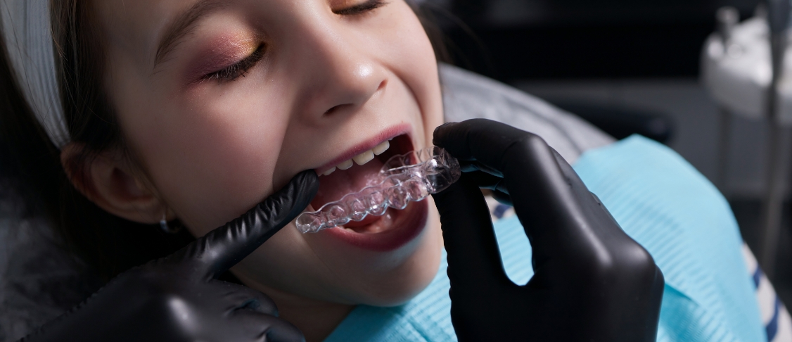 dental aligners img