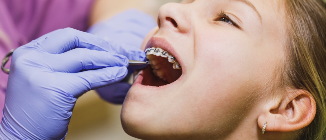 dental braces img
