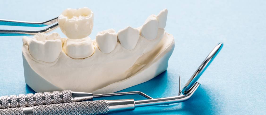 dental crown bridges img dental crown bridges img